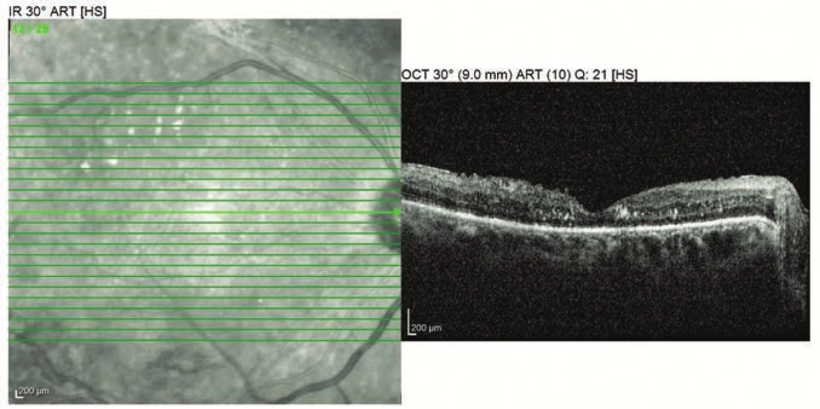 OCT examination of right eye 2 months after surgery (5 months after childbirth)
