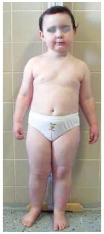 Pacientka s pseudohypoparatyreózou
typu Ia.
Typický fenotyp s obezitou
a kulatým obličejem
(foto archiv autorů)