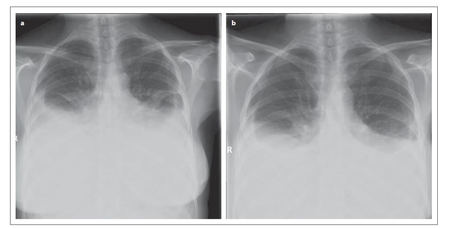 Rentgenový snímek hrudníku pacientky (a) 9. 2. 2012 (předozadní projekce) – je patný oboustranný fl uidothorax
ventrálně po 3. žebro; srdeční stín je nehodnotitelný; mediastinum není rozšířeno. (b) 15. 2. 2012 (předozadní
projekce) – je patrná regrese oboustranného fl uidothoraxu, dosahuje ventrálně po 4. žebro; srdeční stín není
hodnotitelný; mediastinum není rozšířeno.
