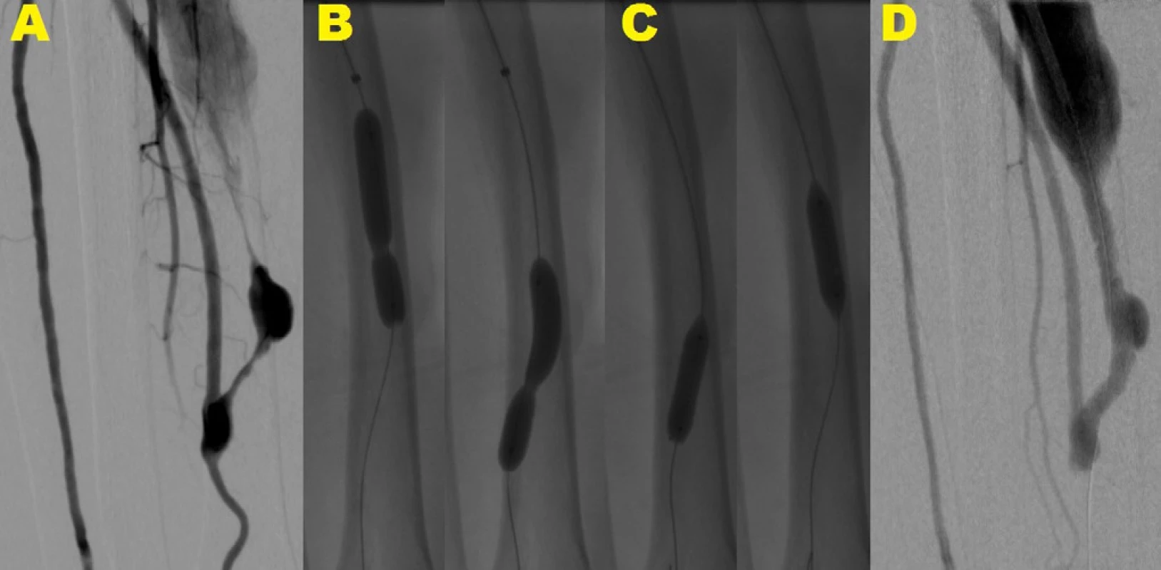 Angioplastika rezistentnej lézie pomocou balónika s čepieľkami <br>
Angiografia predlaktia s rádio-cefalickou AVF s dvoma tesnými stenózami na odvodnej véne tesne za anastomózou a v jej ďalšom priebehu (A). Balónik nekompletne rozvinutý v oblasti rezistentnej lézie (B), Následná dilatácia rezistentných lézií pomocou balónika s čepieľkami s jeho kompletným rozvinutím (C) s konečným výsledkom bez reziduálnej stenózy (D)
