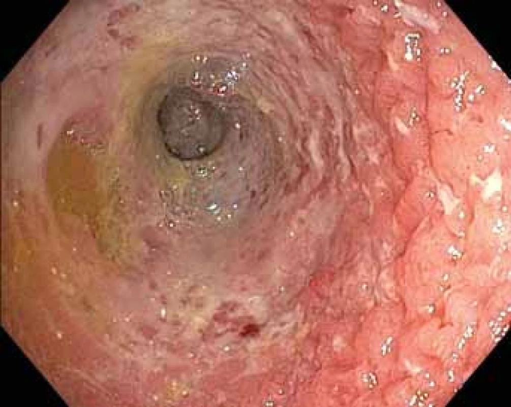Nově diagnostikovaná celiakie s patologickou infiltrací T-buněčného lymfomu jejuna.<br>
Fig. 7. Newly diagnosed celiac disease with complicating
T-cell lymphoma of the jejunum.