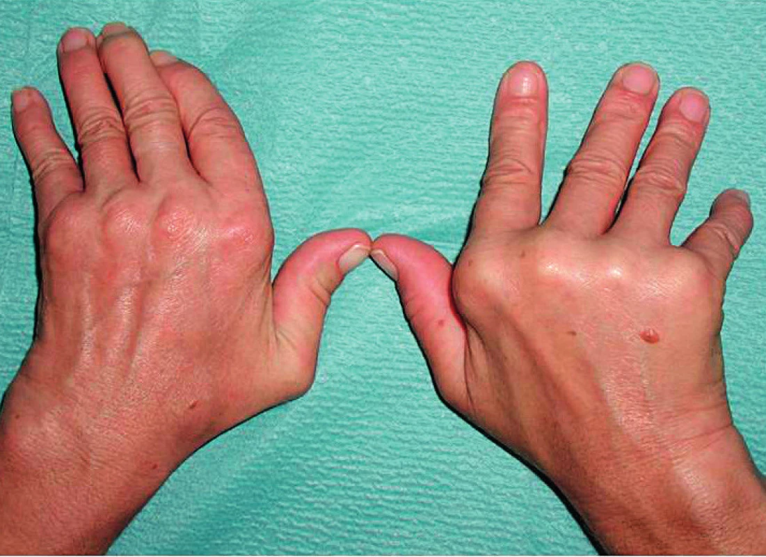 Deformity rukou typu Jaccoudovy artropatie
u systémového lupus erythematodes (archiv II. interní GE
kliniky LF UK a FN, Hradec Králové – vlastní pozorování)