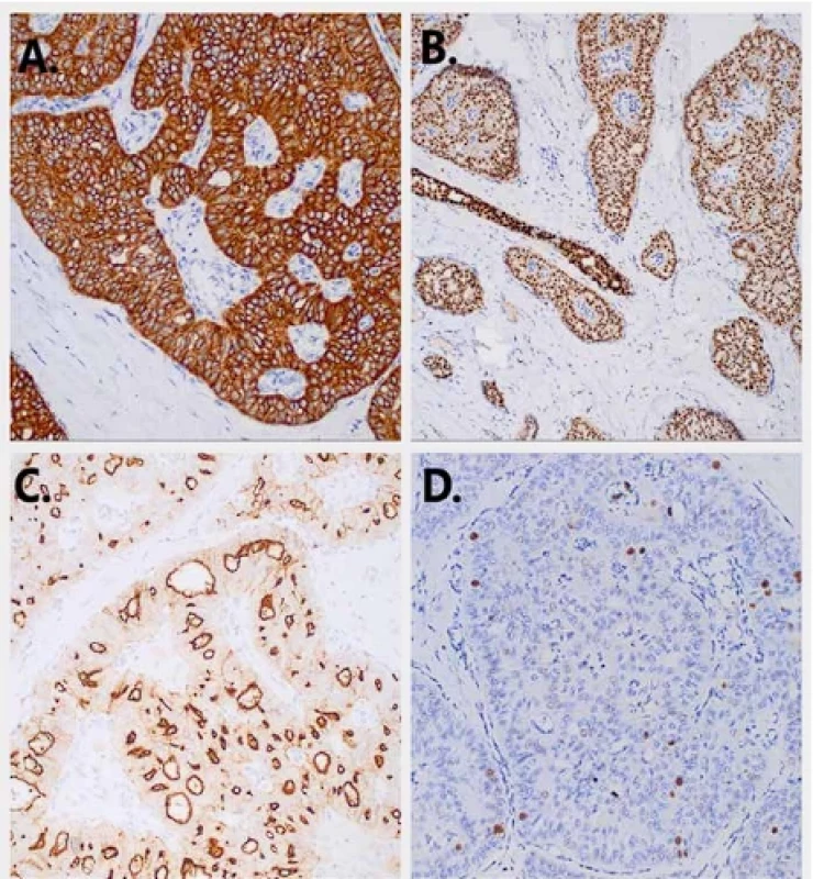 Imunohistochemické charakteristiky nádorových buniek. A. Difúzna cytoplazmatická pozitivita CK5/6; B. Jadrová expresia GATA3; C. Apikálna expresia CD10; D. Nízka prolifer.