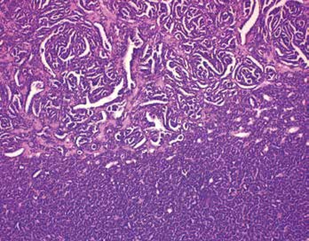 In some areas is tumor composed of tubulopapillary structures (HE,
100x).