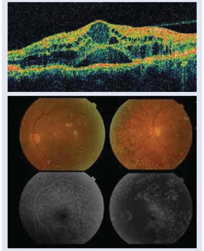 Diabetický edém makuly: 1.1 cystoidné
zmeny v makule, CST 421 μm, s odlúčením
neurosenzória a odlučujúcou sa zadnou kôrou
sklovca (Stratus OCT, Zeiss, USA). 1.2 na fluoresceínová
angiografia rozšírená foveolárna
avaskulárna zóna a presakovanie v neskorých
fázach. Snímky – archív autorky.
