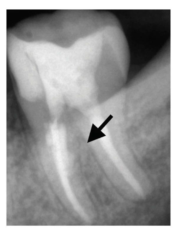 Kontrolní RTG snímek zhotovený 12 měsíců po ošetření s patrným náznakem hojení v oblasti iatrogenní perforace <br>
Fig. 8 Control X-ray taken 12 months after treatment with a clear sign of healing in the area of iatrogenic perforation