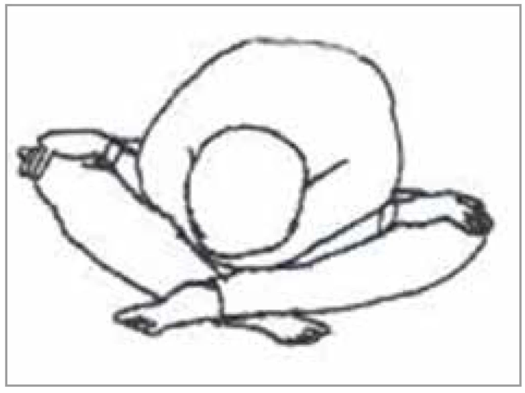 Cvik pre meridián trojitého
ohrievača<br>
Fig. 20. Exercise for triple heater
meridian