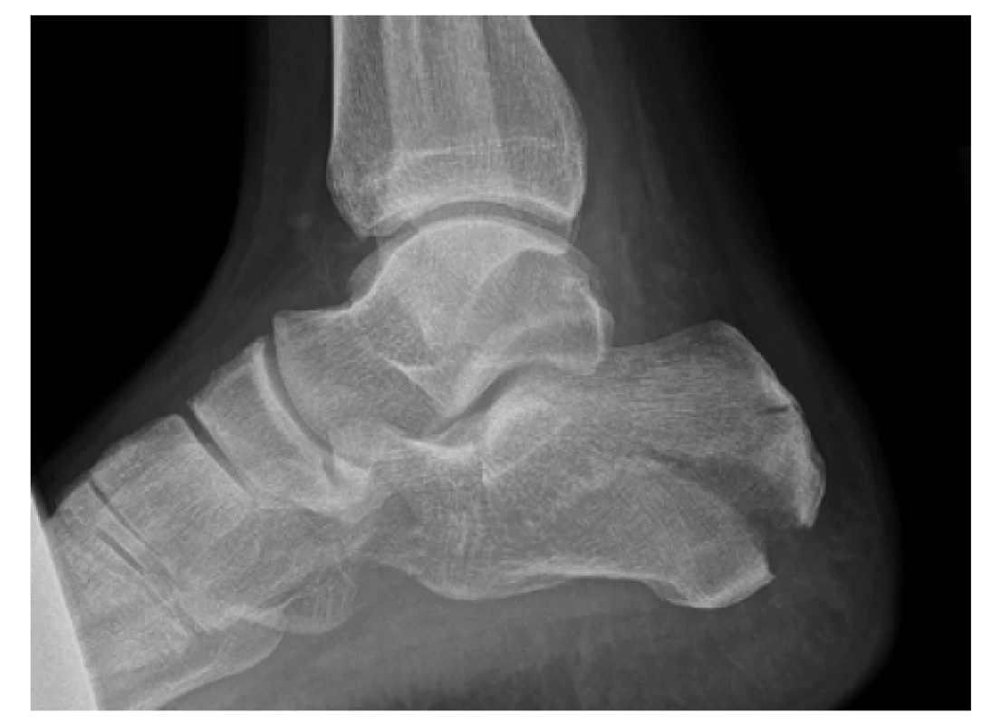 Rentgenový snímek zlomeniny patní kosti typu
kachního zobáku podle Essex-Loprestiho<br>
Fig. 1: Plain radiograph of calcaneal fracture, Essex-
-Lopresti tongue type