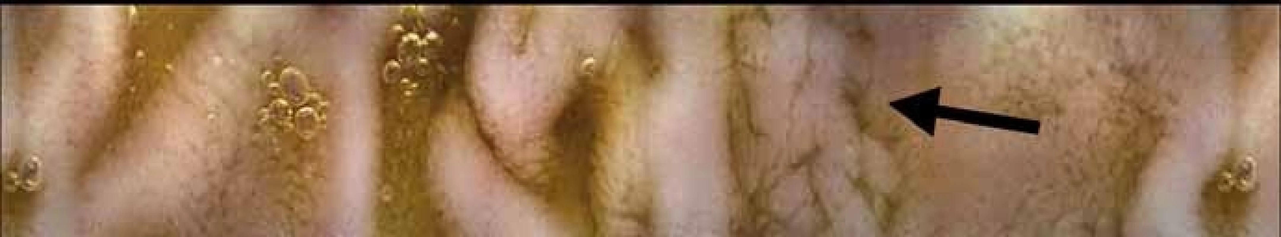 Výraznější Peyerovy plaky v ileu, prase domácí – kapslová endoskopie.<br>
Fig. 5. More pronounced Peyer’s patches in the ileum, domestic pig – capsule
endoscopy.