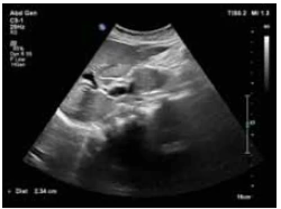 UZ břicha – hraniční šíře hlavy
pankreatu. <br> 
Fig. 2. Abdominal ultrasound – boundary
width of the head of the pancreas.