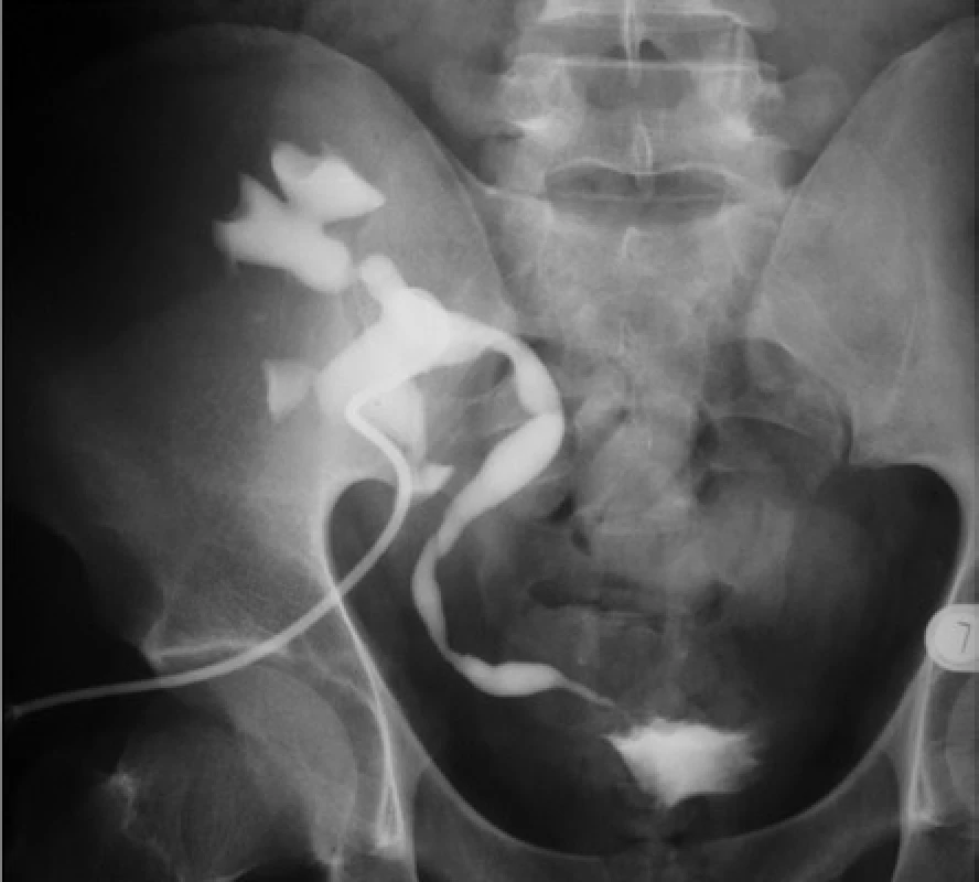 Pyelo-ureterografia. Striktura terminálneho
úseku močovodu<br>
Fig. 10. Pyelo-ureterography. A stricture of the terminal
part of the ureter