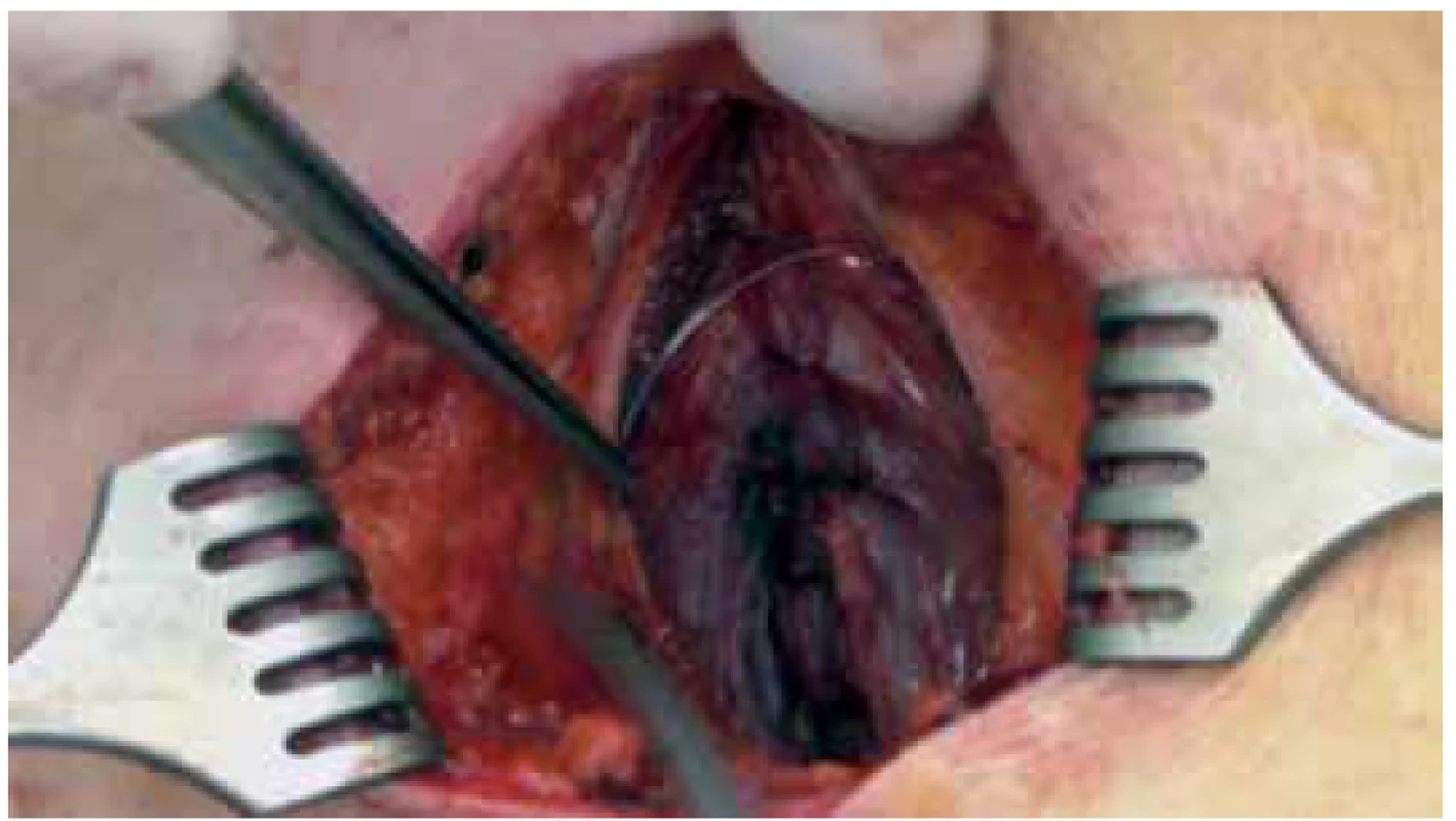 Preperitoneální uložení katétru<br>
Fig. 2. Preperitoneal catheter placement
