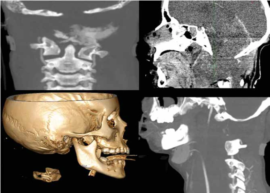 Případy infaustních AOD s významnou dislokací a úmrtím ještě na oddělení emergency<br>
Fig. 1. Terminal cases with severe AOD and extreme dislocation, with death occurring in the emergency department