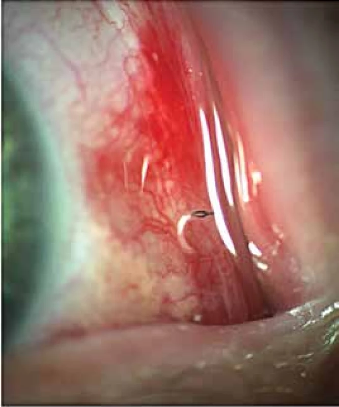 Very rapidly moving living organisms are difficult to capture on photographic slit lamp