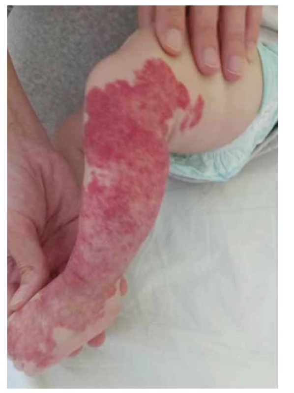 Segmentálny hemangióm postihujúci takmer celú
dolnú končatinu (zdroj: archív autorov).<br>
Fig. 1. Segmental hemangioma affecting almost the entire
lower limb (source: authors’ archive).