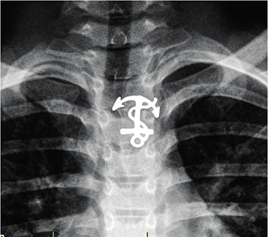 Ostré cizí těleso v jícnu.<br><b> Fig. 7.</b> Sharp foreign body in the esophagus.