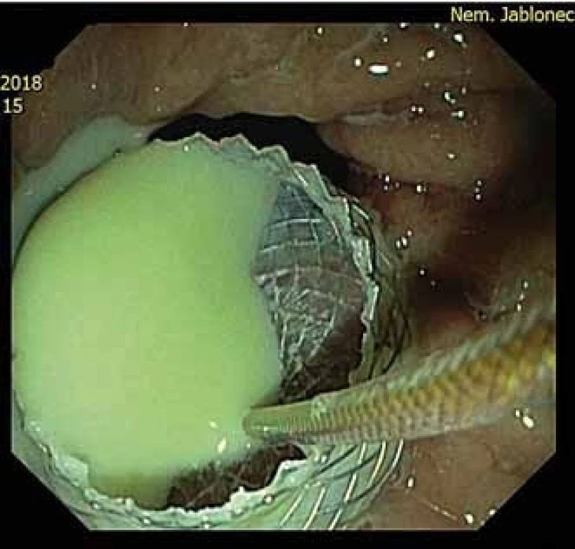 Proximální konec stentum v žaludku po drenáži abscesu.<br>
Fig. 4. A proximal flange in the stomac after abscess drainage.
