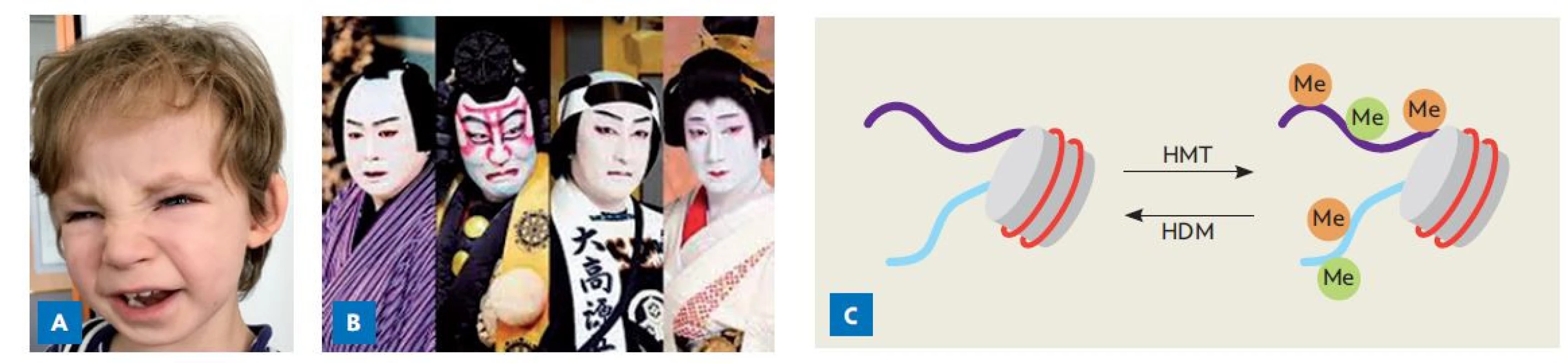 Syndrom kabuki. A – fenotyp chlapce se syndromem kabuki na podkladě patogenní varianty genu KMT2D. B – způsob líčení herců
při tradičním japonském divadle kabuki. C – dynamická metylace histonů, která zvyšuje či tlumí expresi jednotlivých genů. HMT – H3-lysin-
-4-metyltransferáza (kódována genem KMT2D); HDM – histon-H3-lysin-27-demetyláza (kódována genem UTX/KDM6A). Mutace těchto
genů mohou způsobit syndrom kabuki.