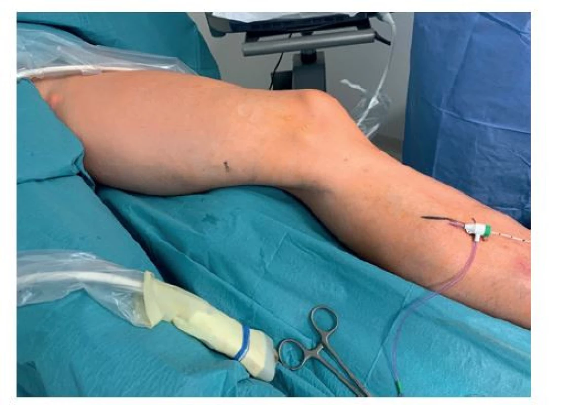 Signální červené laserové světlo na konci laserového
vlákna viditelné pod kůží v třísle<br>
Fig. 2: Signal red laser light at the laser fiber tip visible
under the skin in the groin
