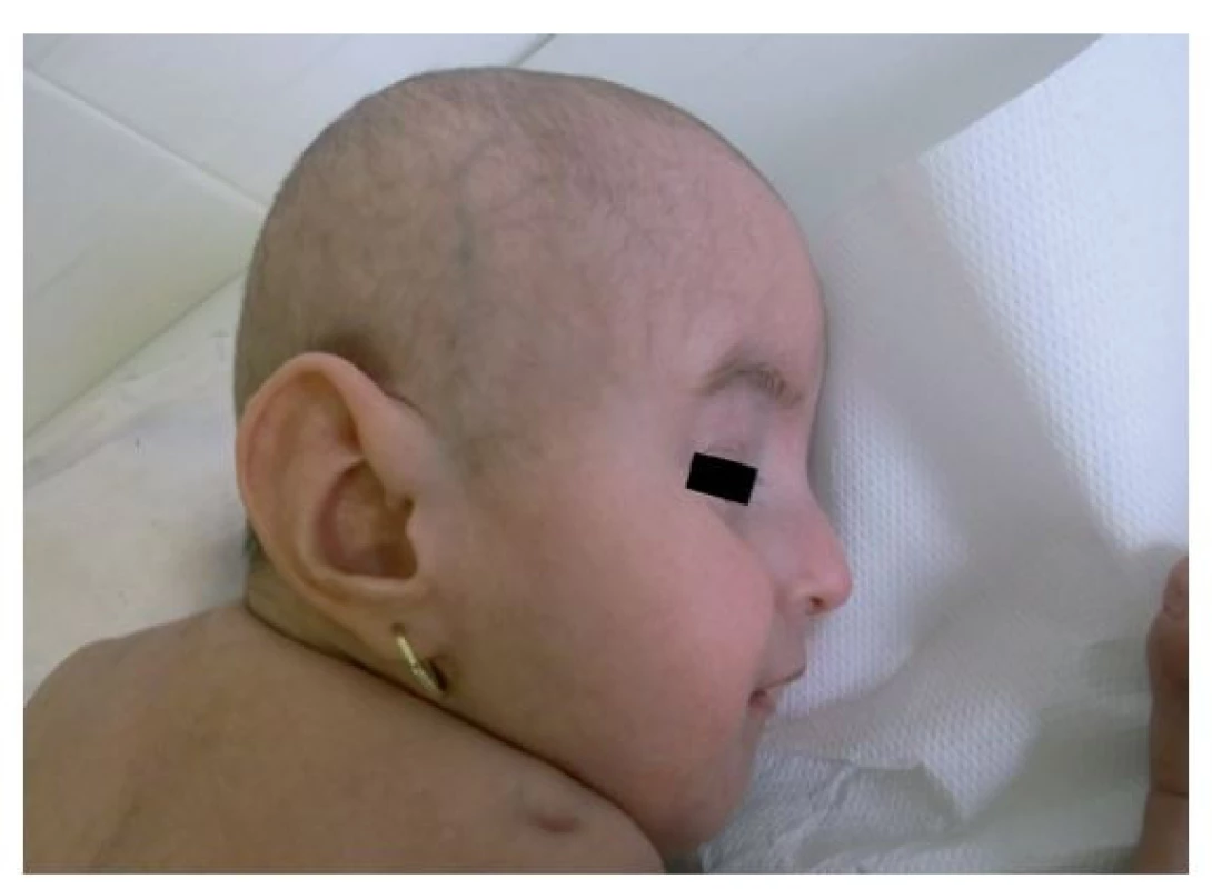 Facies vo veku 17 mesiacov s detailom na veľkú ušnicu.
Viditeľná je atypická jamka v koži nad ramenným kĺbom.