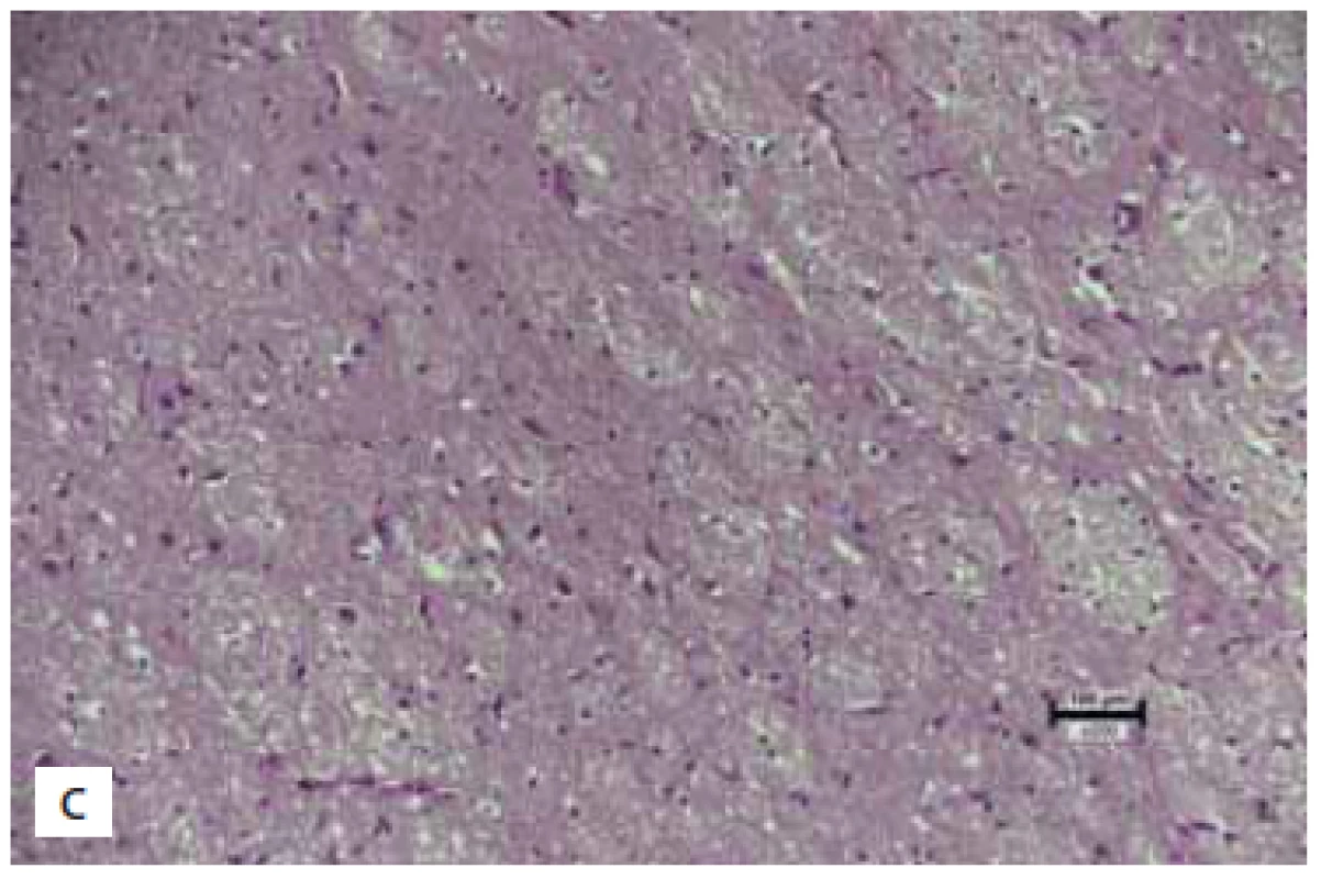 (A) Normal brain tissuie in the control group (score 3). (B)
Significant gliosis in the trauma group (score 0). (C) Mild gliosis
in the sumatriptan group (score 2) (hematoxylin eosin 200×). <br> 
(A) Normální mozková tkáň v kontrolní skupině (skóre 3).
(B) Významná glióza ve skupině s traumatem (skóre 0). (C) Mírná
glióza ve skupině na sumatriptanu (skóre 2) (hematoxylin-eozin
200×).