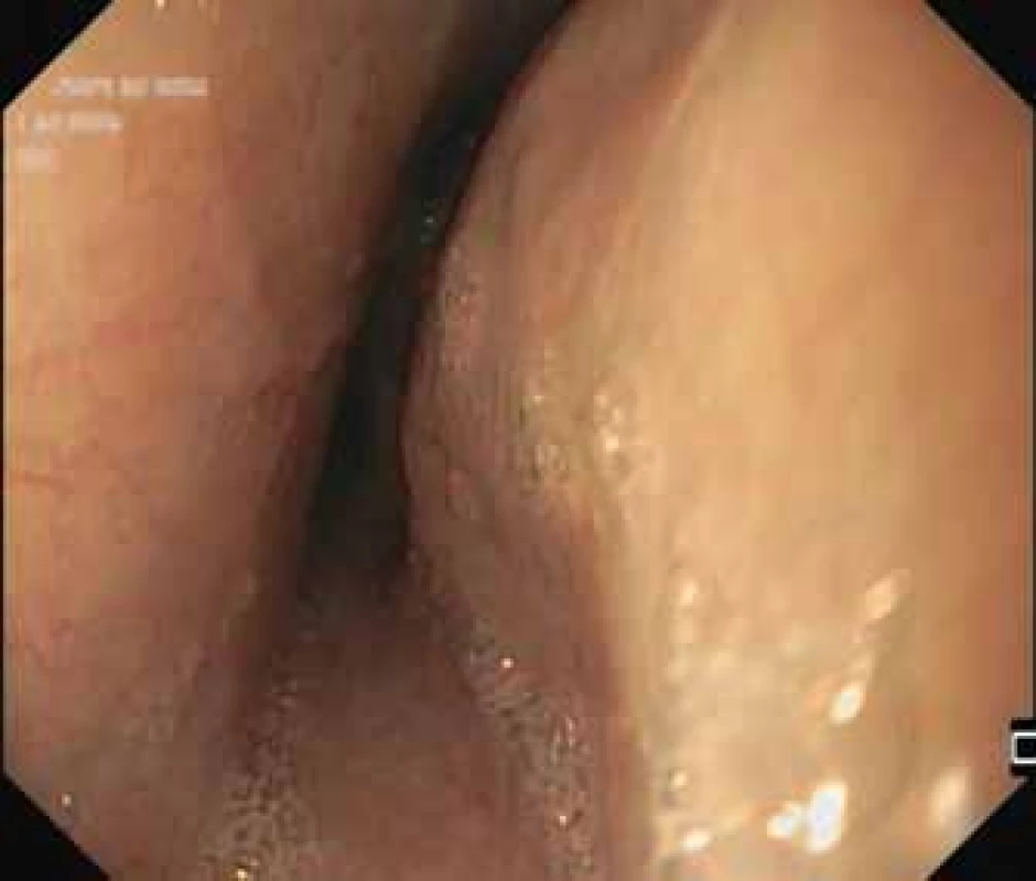 Endoskopický obraz,
extramurální stenóza středního jícnu
s normálním slizničním nálezem.<br>
Fig. 4. Endoscopic image, extramural
stenosis of middle oesophagus with
normal mucosa.
