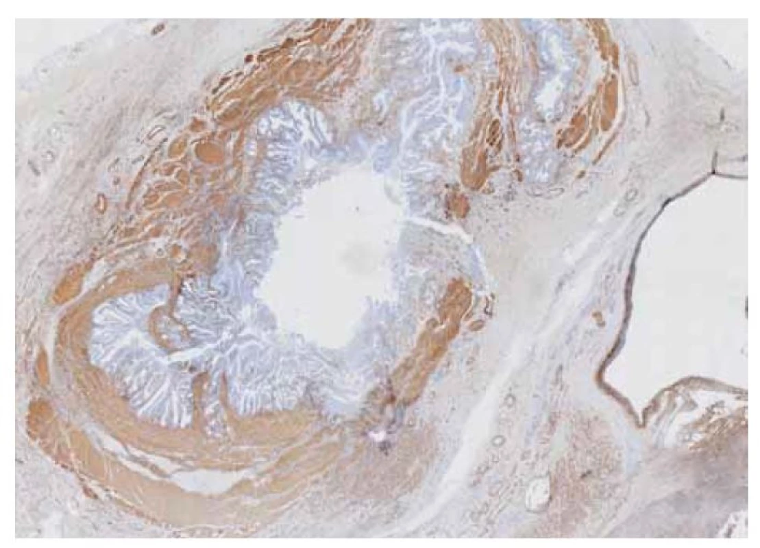 Hypertrofická hladká svalovina adenomyomatózy (SMA+).<br>
Fig. 7. Hypertrophic smooth muscle adenomyomatosis (SMA+).