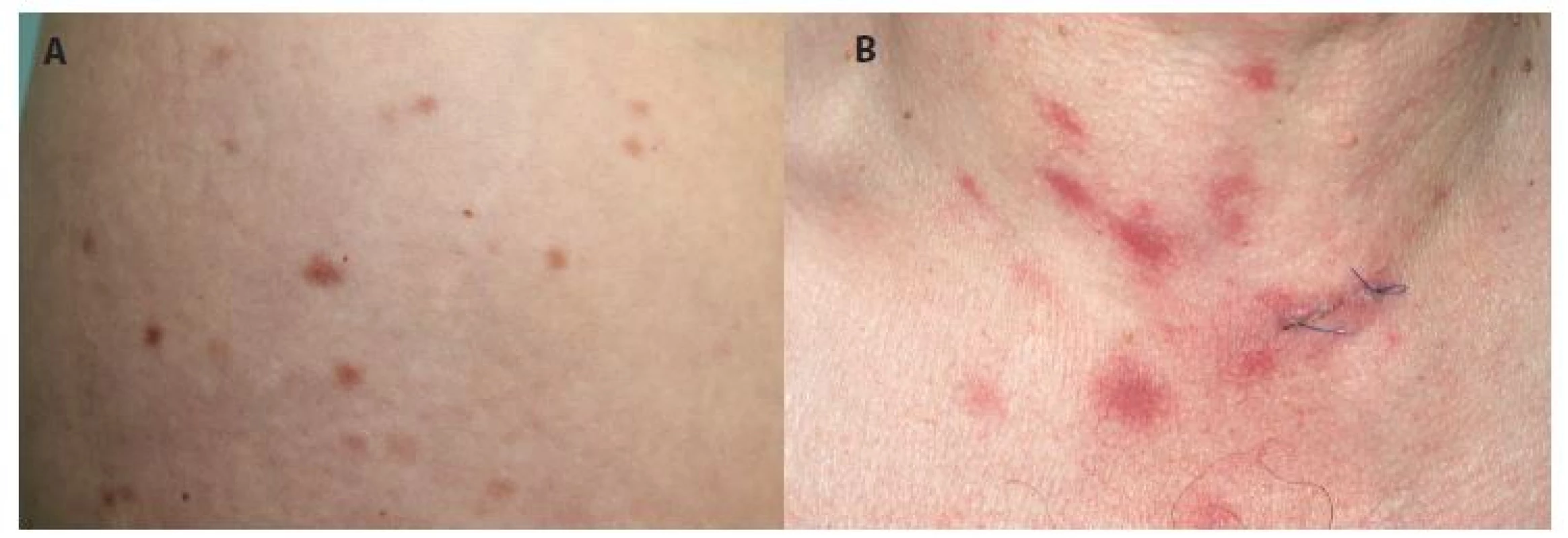 Urticaria pigmentosa
a) Červenohnědé makulopapuly o velikosti několika mm<br>
b) makulopapuly o velikosti několika cm