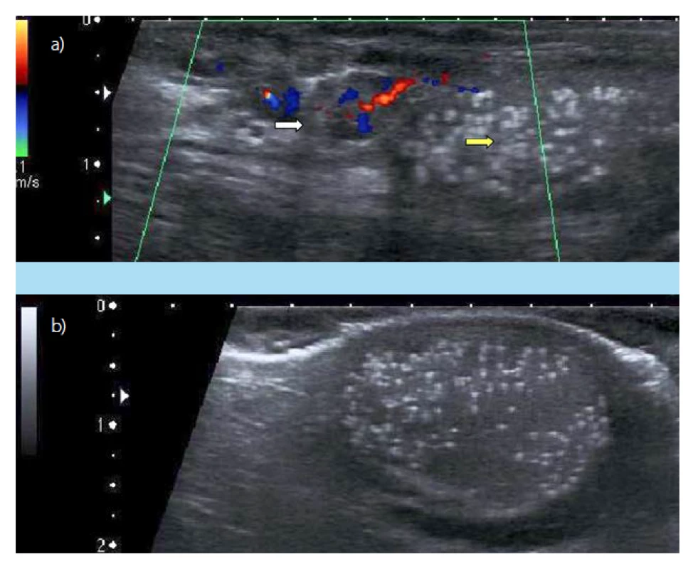 a, b. a) Dopplerovská
sonografie varlete vlevo: varikokéla
(bílá šipka), TM (žlutá šipka)
(2012, pacient č. 1); b) USG pravého
varlete s mikrolitiázou, malá
hydrokéla (2012, pacient č. 1)<br>
Fig. 2. a, b. a) Doppler ultrasound
examination of the left
testis: varicocele (white arrow),
Testicular microlithiasis (yellow
arrow) (2020, patient No 1).
b) Ultrasonound examination of
the right testis: Testicular microlithiasis,
small hydrocele) (2020,
patient No 1)