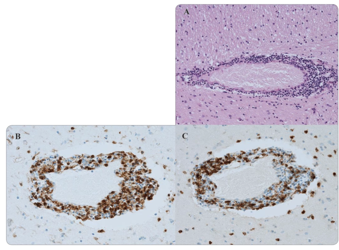 Histologické vyšetření bazálních ganglií (zvětšení 100×).<br>
A. Hematoxylin-eozinové barvení perivaskulární infi ltrace.<br>
B. Imunohistochemické barvení perivaskulární oblasti pomocí CD4.<br>
C. CD8 znaku.