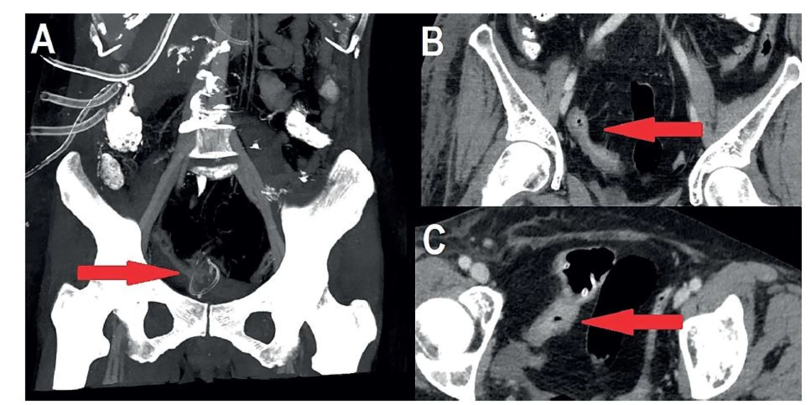 A – CT zobrazující cizí těleso v malé pánvi, B+C – stenotická klička ilea s edematózní střevní stěnou<br>
Fig. 3: A – CT view of a foreign object in the lesser pelvis; B+C – stenotic ileal loop with edematous intestinal wall