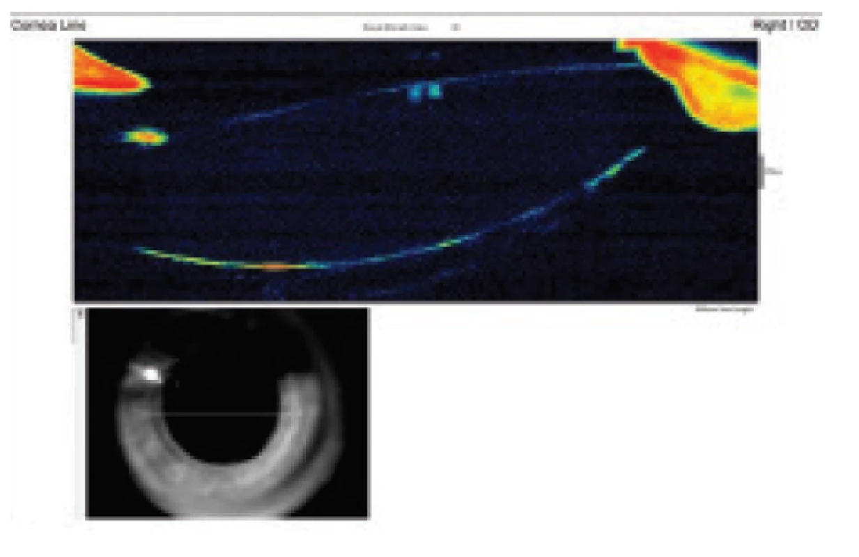 Anterior-segment OCT after lavage displays space
behind IOL collapsed and bordered with frilled posterior
capsule