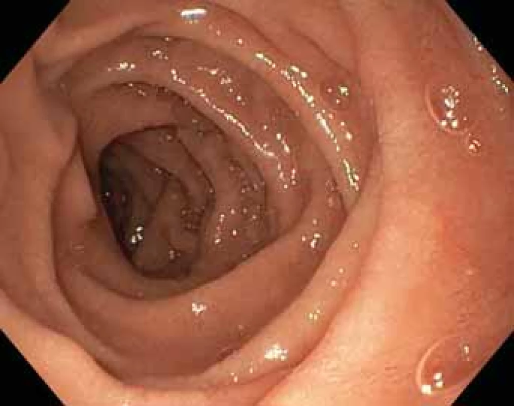 Postbulbární duodenum – remise.<br>
Postbulbar duodenum – remission.