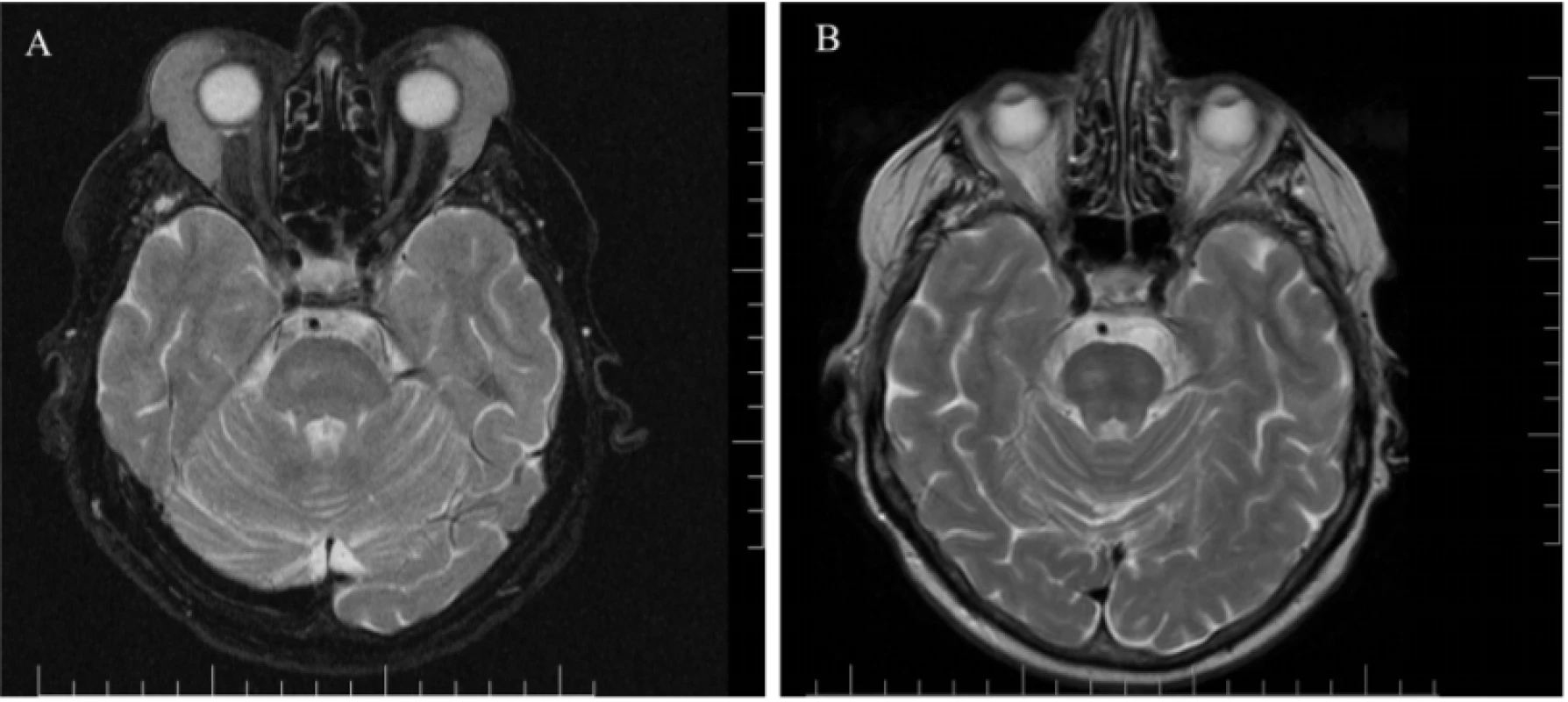 Fig. 2. Patient 1 – magnetic resonance of head: axial cross-section, T2 weighting, bilateral lymphoma
of upper eyelids<br>
A) at time of diagnosis 02/2018<br>
B) following chemotherapy and immunological treatment 01/2019