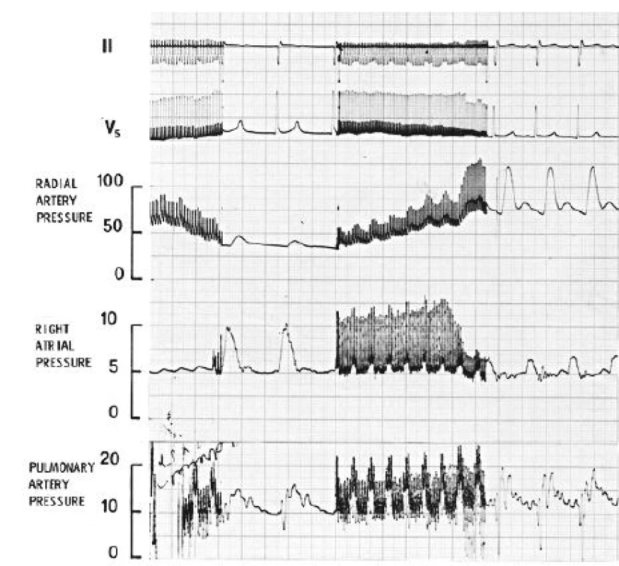 Úsek záznamu kontinuálního elektrokardiogramu (svody II a V5), tlaků v a.
radialis, pravé síni a a. pulmonalis během celkové anestezie