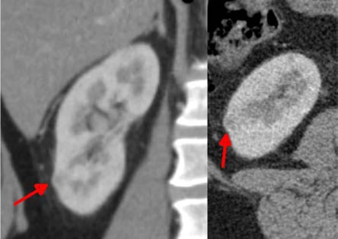 Menší ložisko konvexity dolního pólu o velikosti
8 mm, odstraněno jako šesté, bez ischemie<br>
Fig. 6. Smaller lesion of 8mm located on the lower
pole convexity, it was resected as the sixth one, without
ischemia