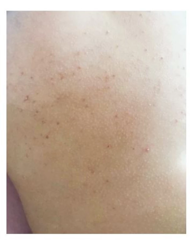 Whirlpool
dermatitida