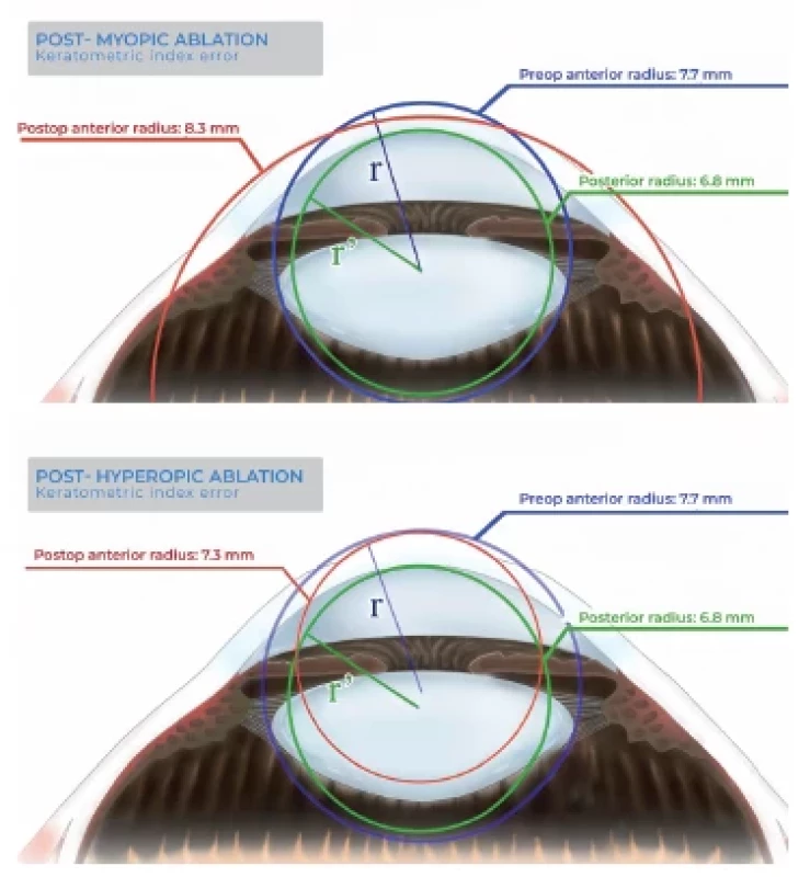 After myopic ablation, the anterior curvature is flattened
(top), and, after hyperopic ablation (bottom), the anterior
curvature is steepened, while the posterior one is unchanged in
both instances. This causes the assumptions of the Keratometric
Index to be invalidated