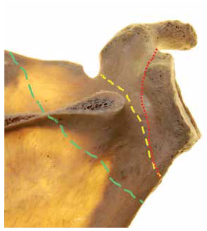 Fractures of scapular neck. Right scapula, posterior
view, with scapular spine resected. Anatomical neck fracture
– red, surgical neck fracture – yellow, transspinous
neck fracture – green.