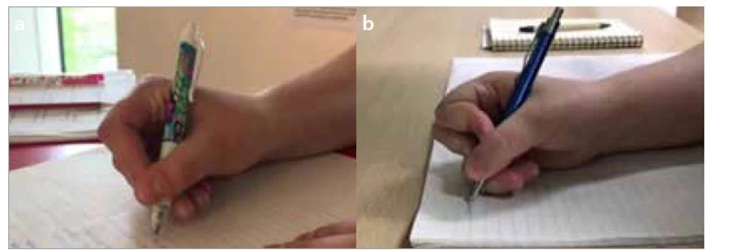 a,b. Boční palcový úchop – a) tříprstý, b) čtyřprstý.<br>
Fig. 4a,b. Lateral thumb grip – a) lateral tripod grip, b) lateral quadruped grip.