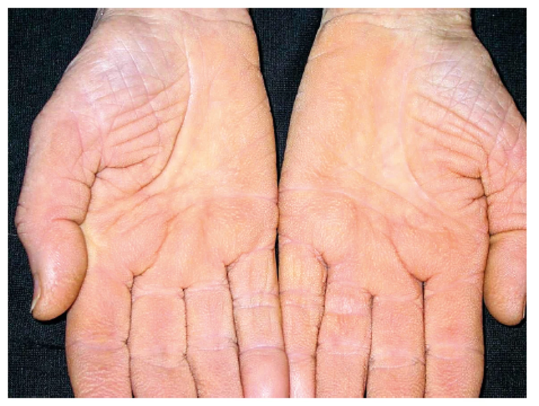 Acanthosis palmaris (tripe palm)