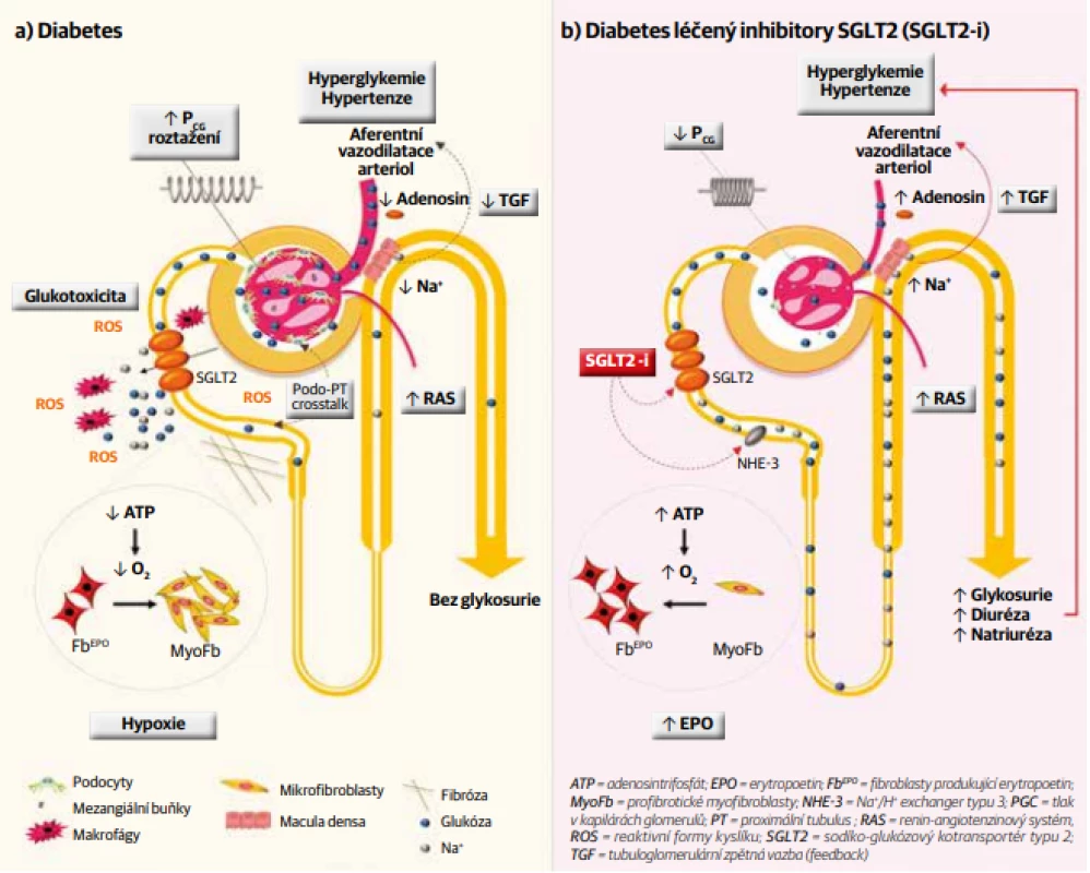 Nefroprotektivní efekt inhibitorů SGLT2. [Upraveno podle publikace Barutta F, et al. SGLT2 inhibition to address the unmet needs in diabetic nephropathy.
Diabetes Metab Res Rev 2019;35:e3171.]