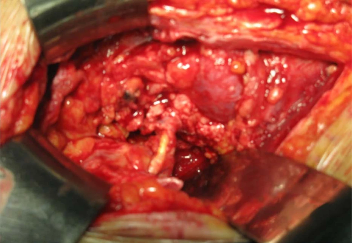Nekróza močovodu, v ktorom je zavedená endoprotéza<br>
Fig. 5. Necrosis of ureter, an inserted uretal stent can be seen