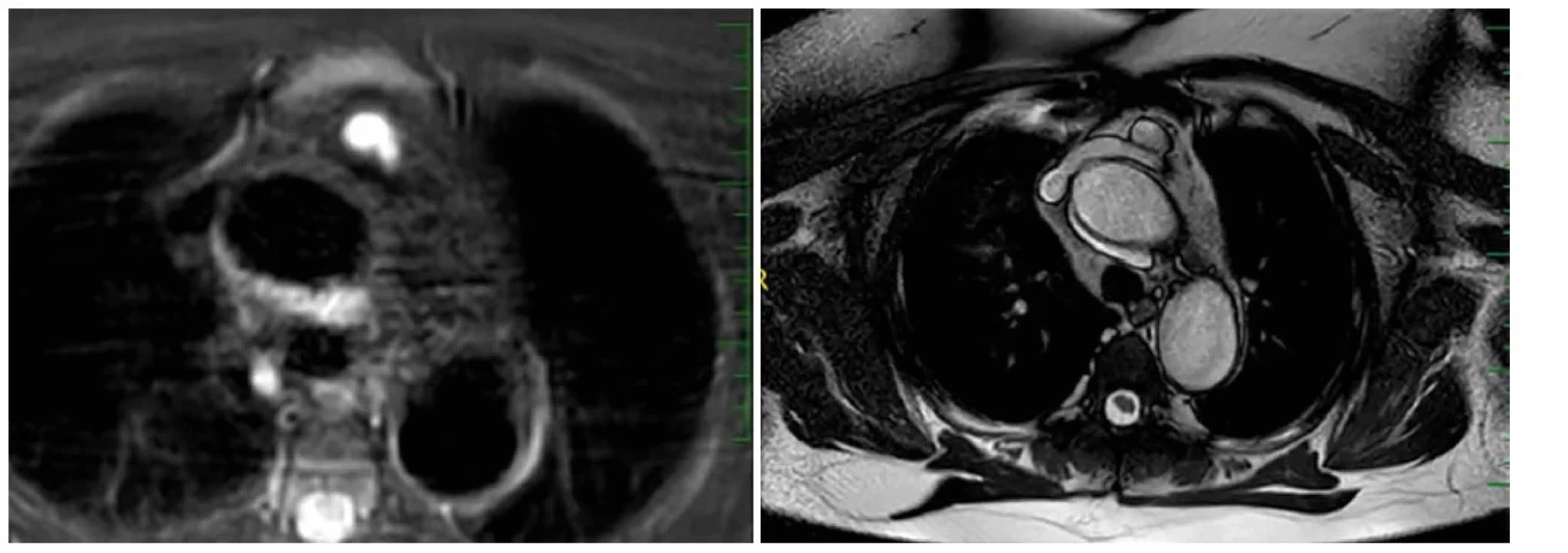 MRI, adenom příštítného tělíska ve tkání thymu<br>
Fig. 3: MRI, parathyroid adenoma in thymic tissue