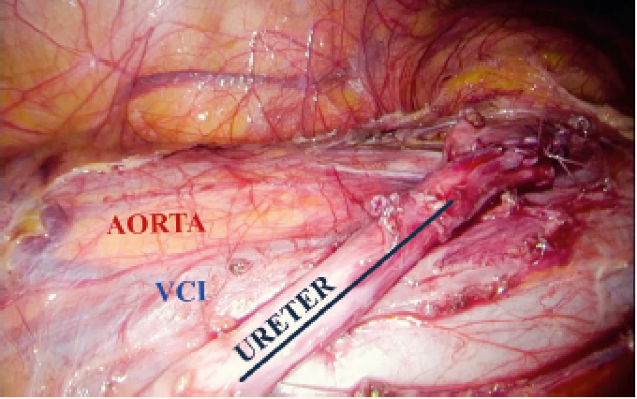 Provedená rekonstrukce, tj. antepozice močovodu před dolní dutou žílou s uretero-ureteroanastomózou zajištěnou JJ stentem.<br>
Performed anteposition of the right ureter in front of the inferior vena cava with uretero-ureteroanastomosis secured by a JJ stent.