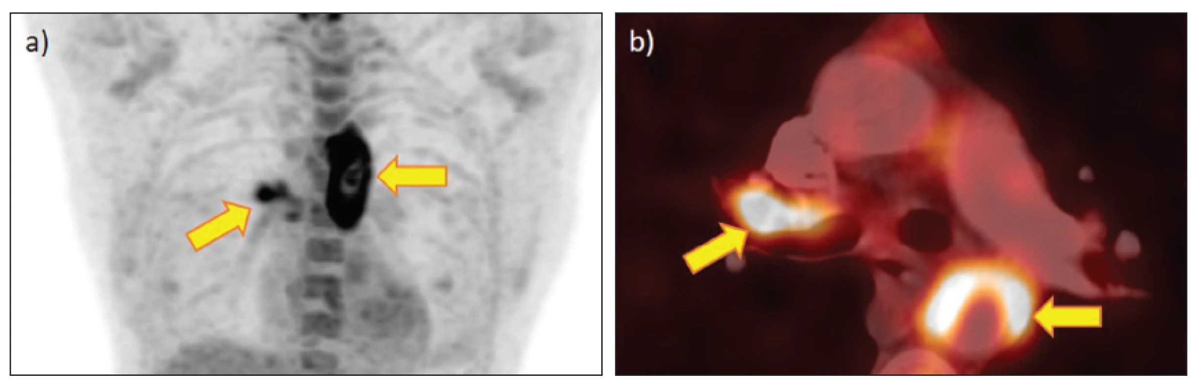 FDG PET/CT u 26leté pacientky s Takayasu arteritidou, postižení pravé plicní tepny s preobliterační stenózou větve pro horní
lalok: a) MIP, b) PET/CT fúze, postižení plicnice (šikmá šipka) a desc. aorty (horizontální šipka).