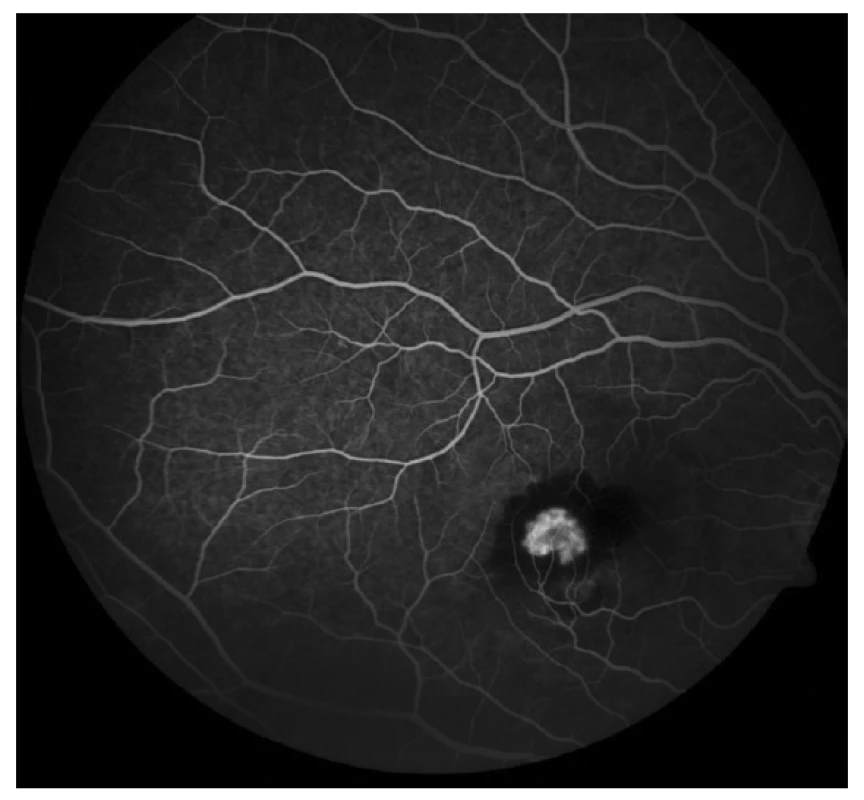 Fluorescenční angiografie (FAG) OD: aktivní klasická
CNV juxtafoveolární lokalizace