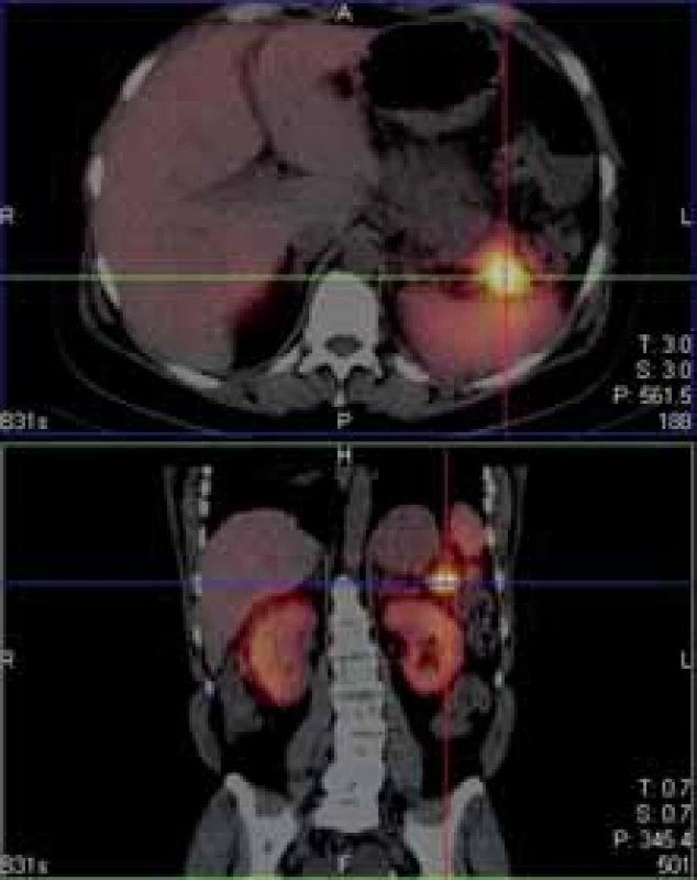 Ložisko zvýšeného záchytu 111-In pentetreotidu v kaudě
pankreatu.<br>
Fig. 3. 111-In pentetreotide positive lesion of tail of pancrea