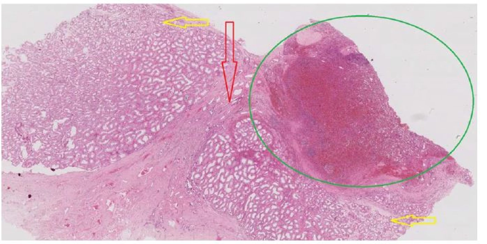 Histologický preparát: zelenou je označena tkáň sleziny, červená šipka směřuje k rete testis, žluté šipky
označují parenchym varlete (se semenotvornými kanálky), zvětšeno 100x, barvení H&E<br>
Fig. 2. Histological specimen: the splenic tissue is marked green, the red arrow points to the rete test
