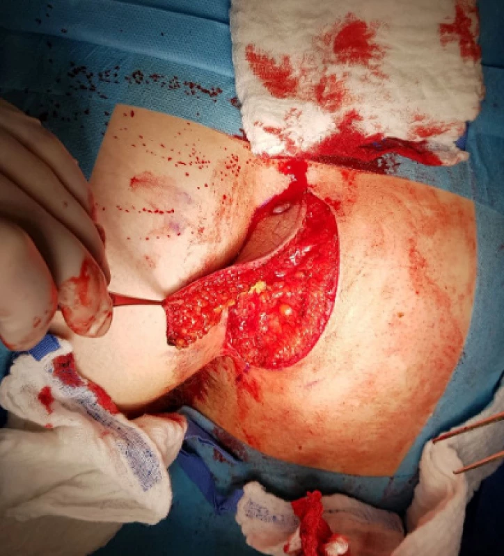 Exstirpace tkáně<br>
Fig. 2: Tissue extirpation